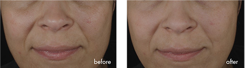 Prevage Wrinkle Smoother Nasolabial Folds